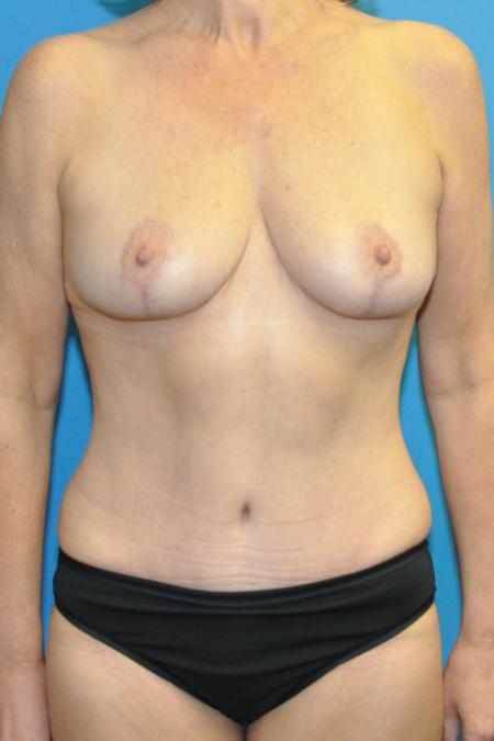 Mommy Makeover before and after - after