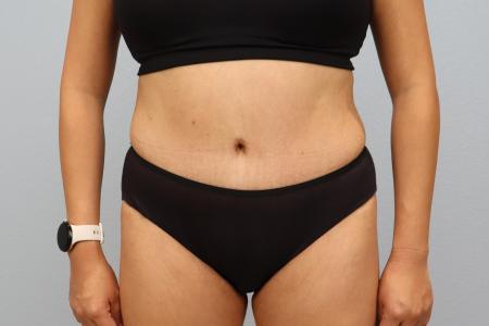 Skin Removal Surgery: Tummy Tuck with Lipo 360 before and after - after