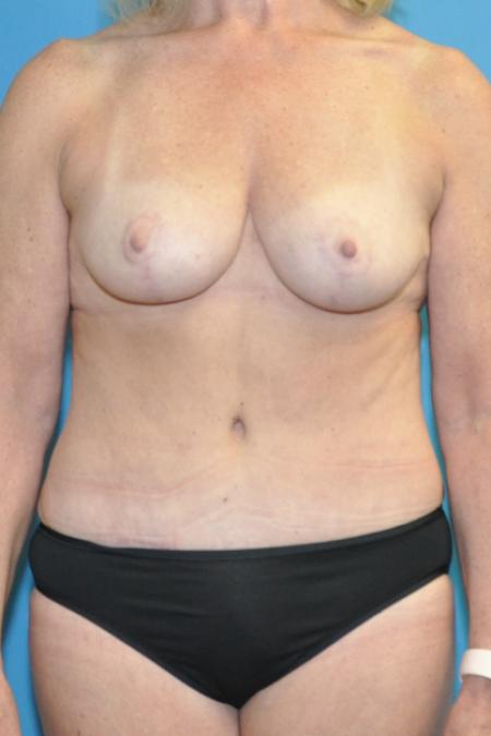 Mommy Makeover before and after - after
