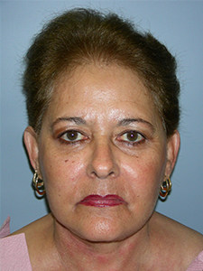 Facelift before and after - after