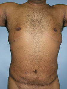 Liposuction before and after - after