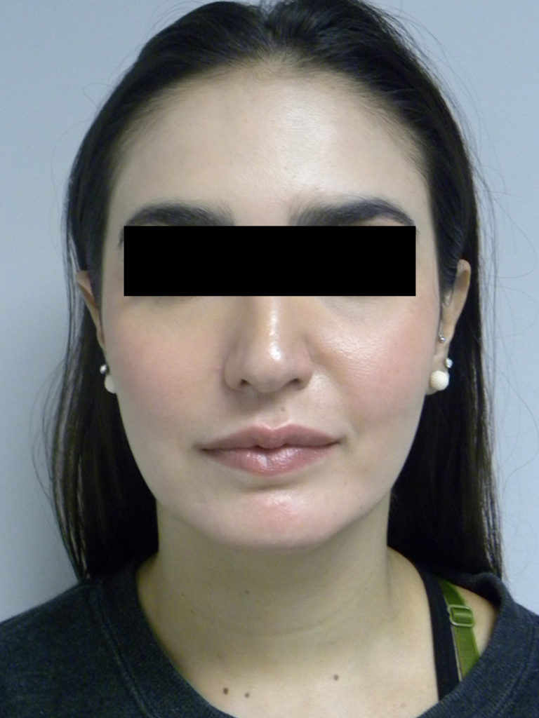 Chin before and after - after