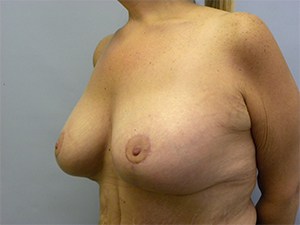 Breast Lift before and after - after