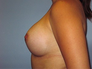 Breast Augmentation before and after - after
