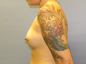 Breast Augmentation before and after - after