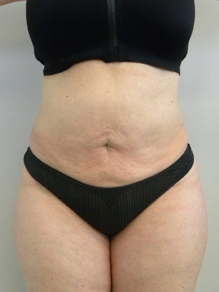 Liposuction before and after - after