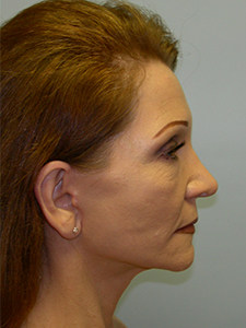 Facelift before and after - after
