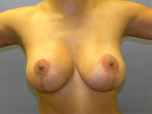 Breast Augmentation before and after - after