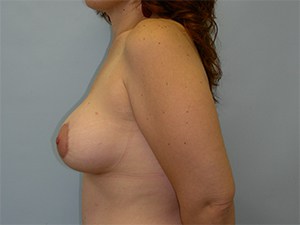 Breast Lift before and after - after