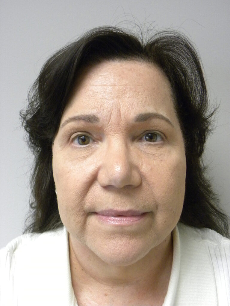 Blepharoplasty before and after - after