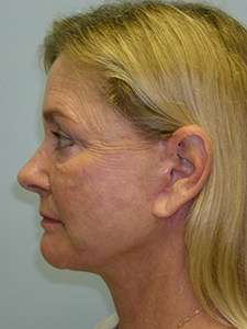 Facelift before and after - after