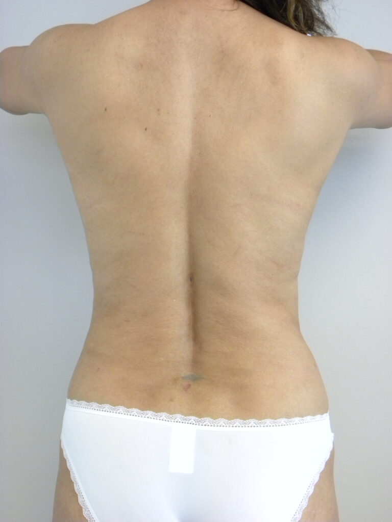 Liposuction before and after - after