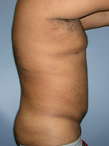 Liposuction before and after - after