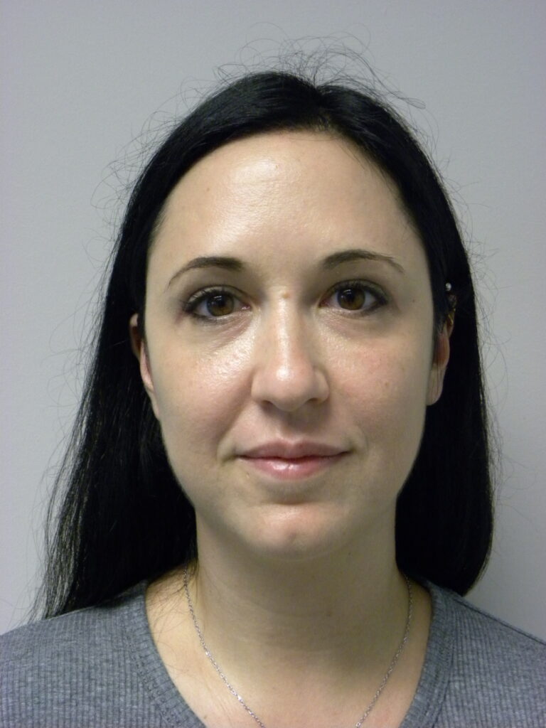 Blepharoplasty before and after - after