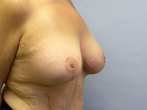 Breast Lift before and after - after
