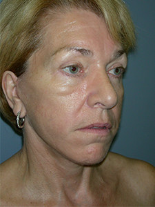 Facelift before and after - after