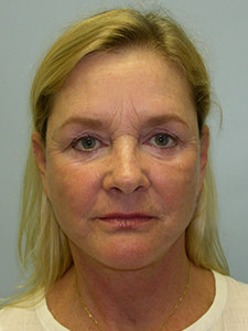 Facelift before and after - after