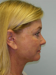Facelift before and after - after