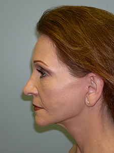 Facelift before and after - after