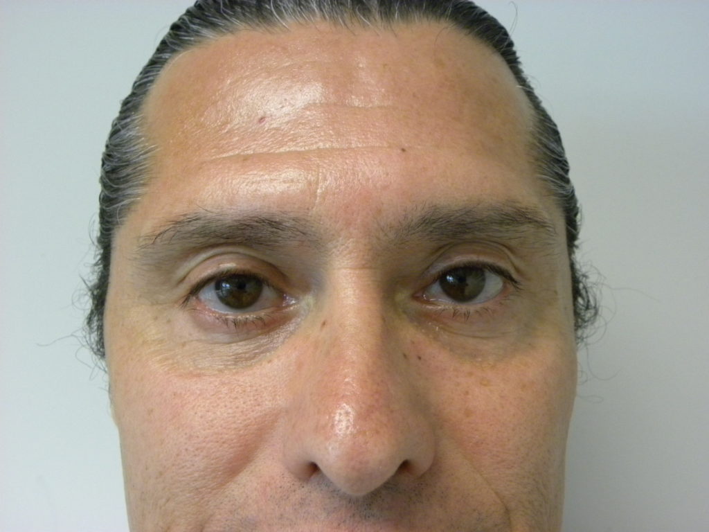 Blepharoplasty before and after - after