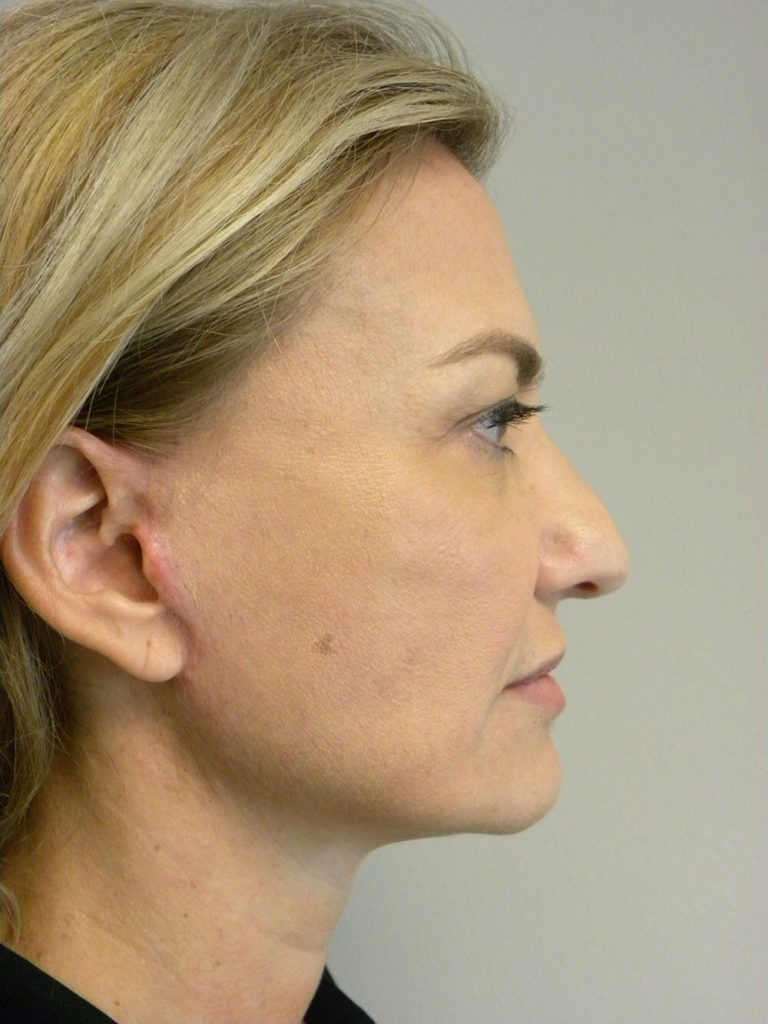 Facelift before and after - after