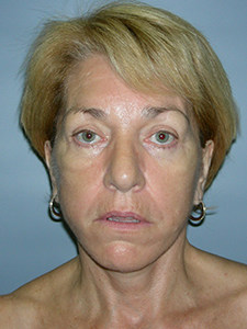 Facelift before and after - after