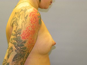 Breast Augmentation before and after - after