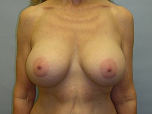 Breast Augmentation before and after - after