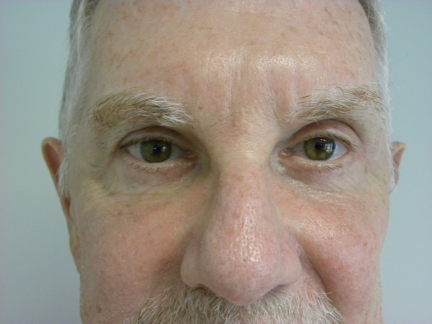 Blepharoplasty before and after - after