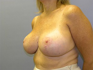 Breast Reduction before and after - after