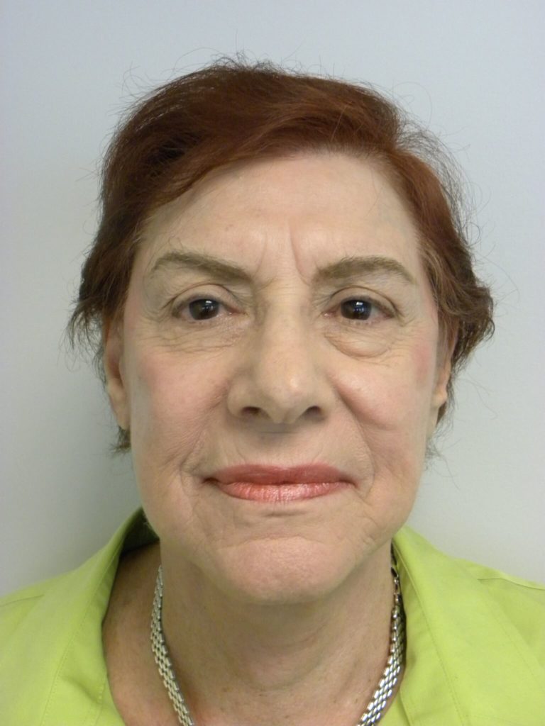 Facelift before and after - after