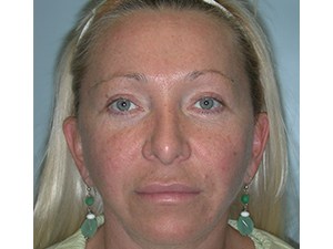 Facelift before and after - after