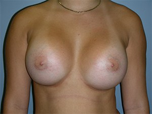 Breast Augmentation before and after - after