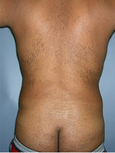 Liposuction before and after - after