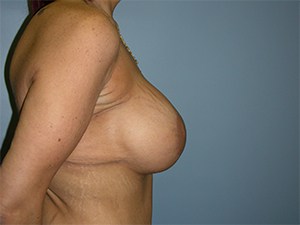 Breast Lift before and after - after