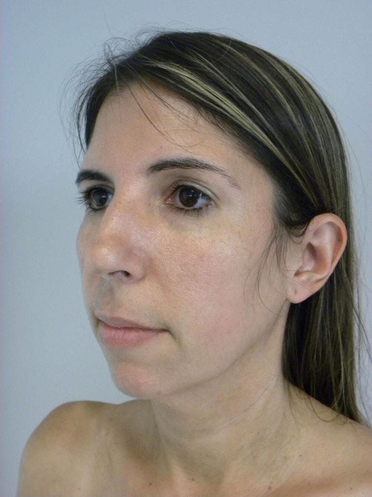 Chin before and after - before