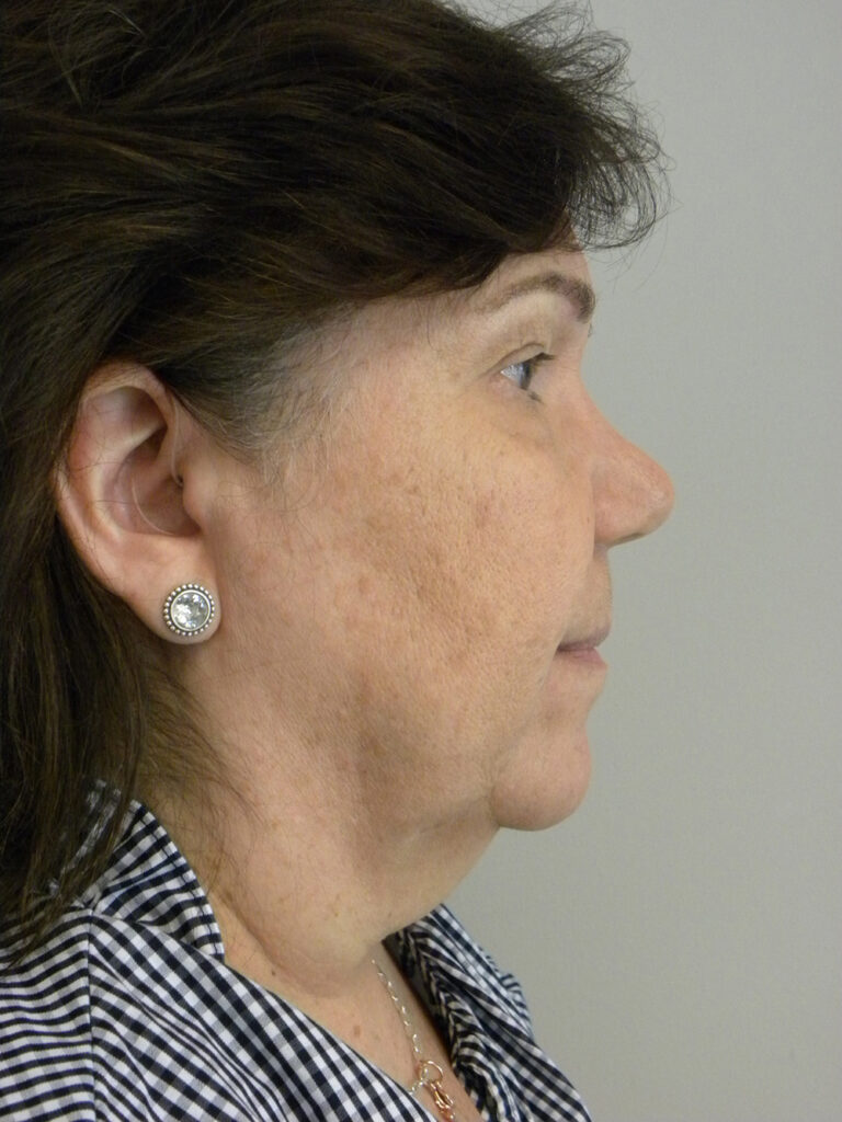 Blepharoplasty before and after - before