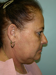Facelift before and after - before