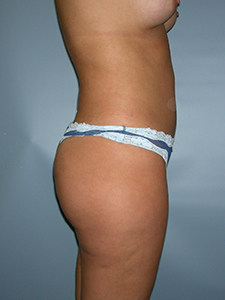 Liposuction before and after - before