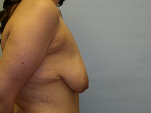 Breast Lift before and after - before