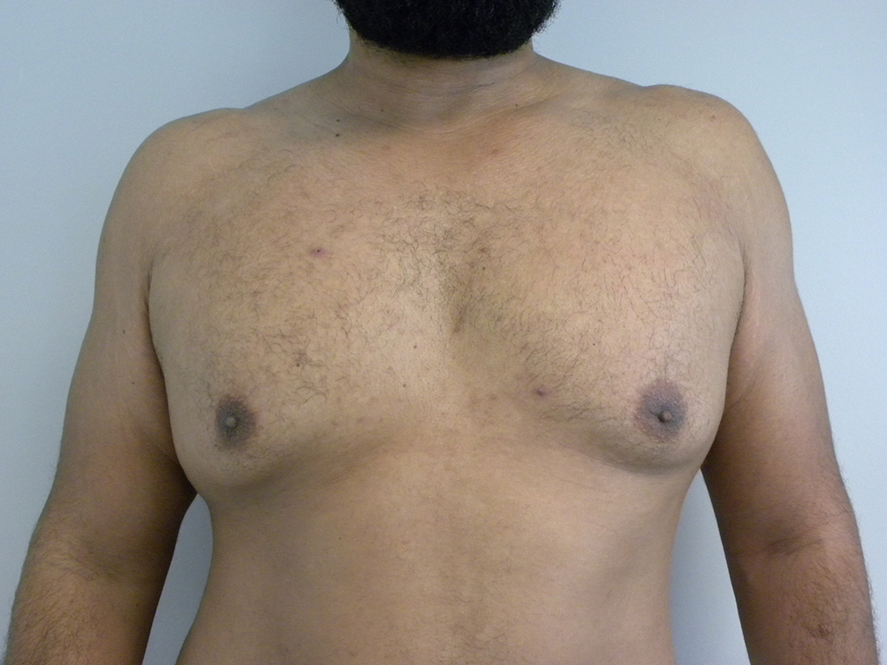 Liposuction before and after - before