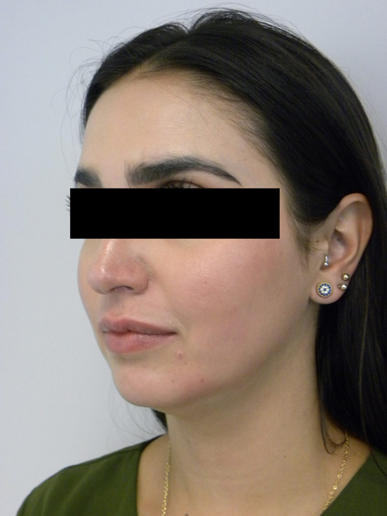 Chin before and after - before