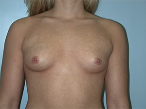 Breast Augmentation before and after - before