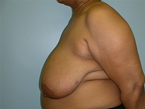 Breast Reduction before and after - before