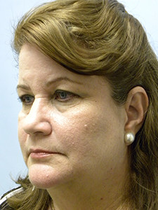 Facelift before and after - before