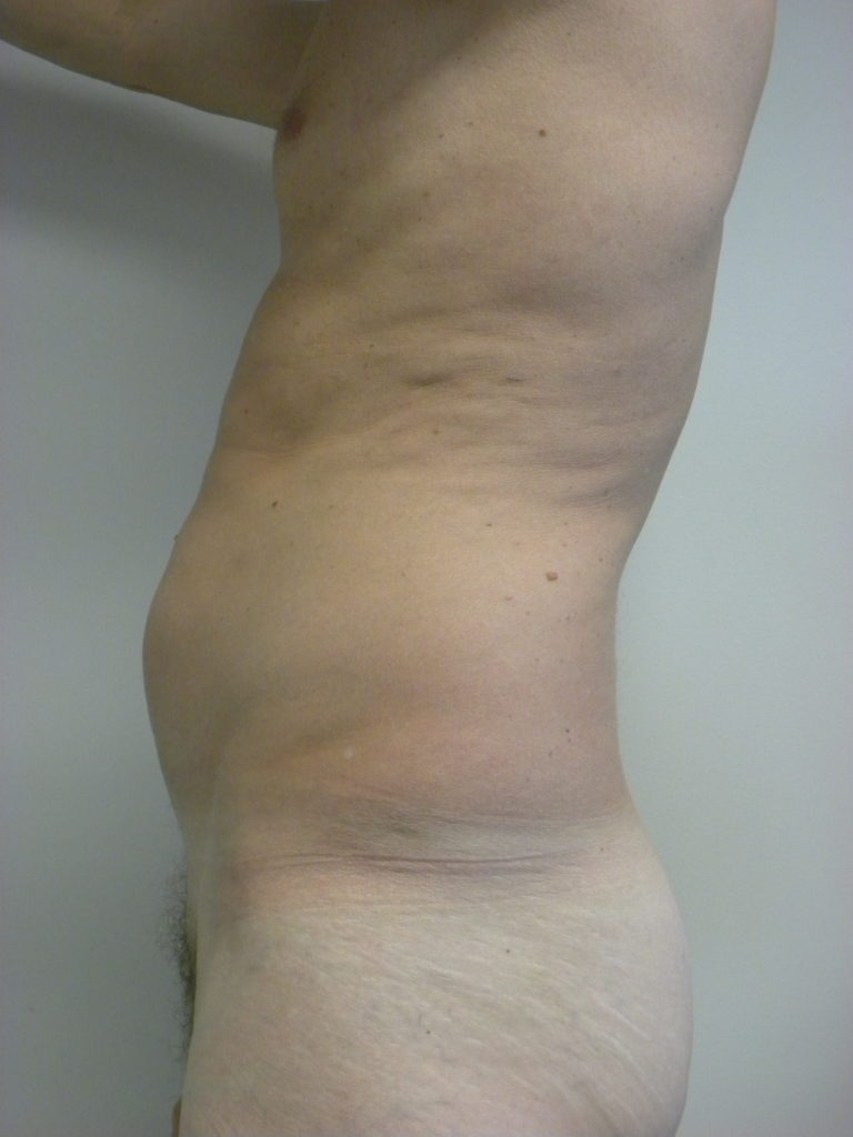 Liposuction before and after - before