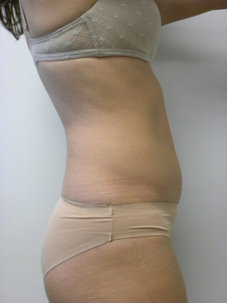 Liposuction before and after - before