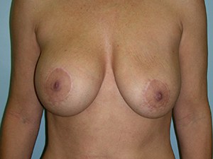 Breast Augmentation before and after - before
