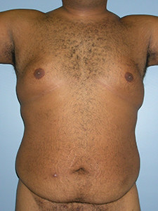 Liposuction before and after - before