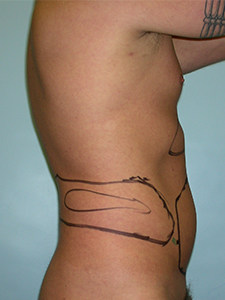 Liposuction before and after - before